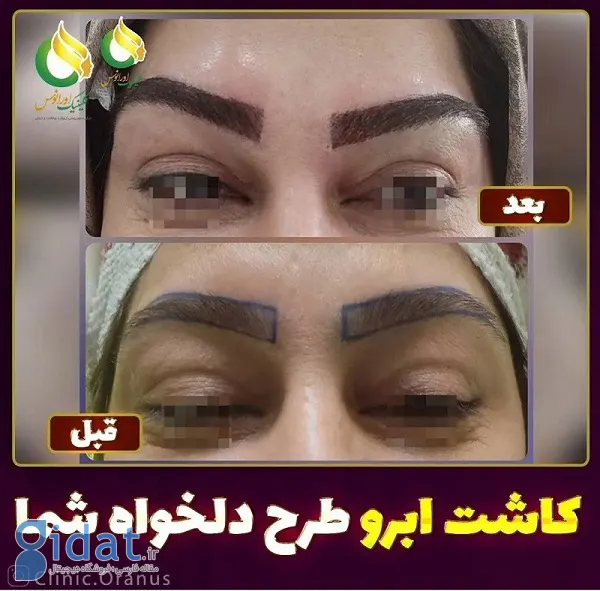 نمونه های کاشت ابرو در کلینیک اورانوس
